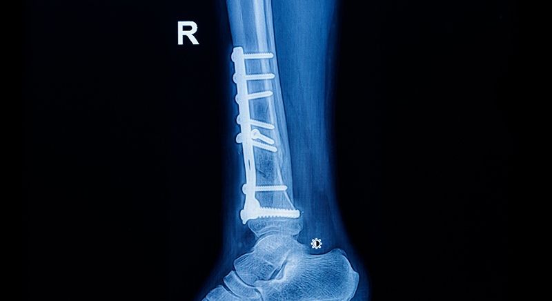 radiografía de tibia